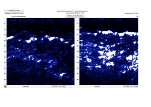 stratigrafia addominale, donna obesa di 47 anni, in menopausa, in riabilitazione nutrizionale